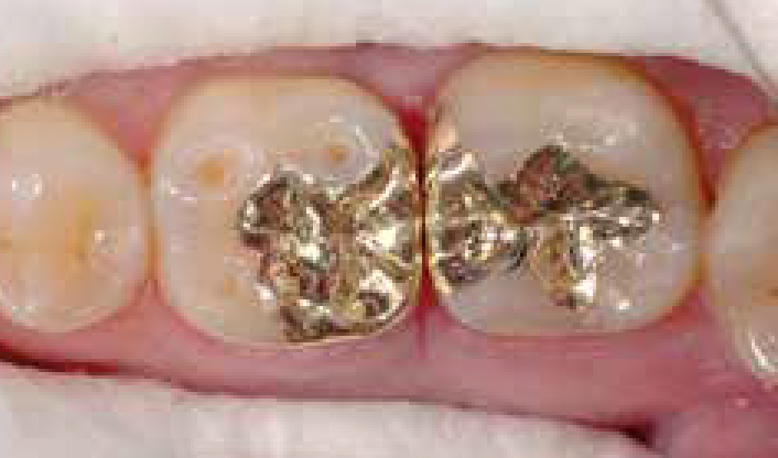 Нанесение Хонигум Патти - этап 1